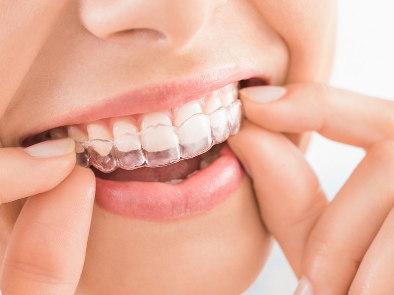 ortodoncia Invisalign