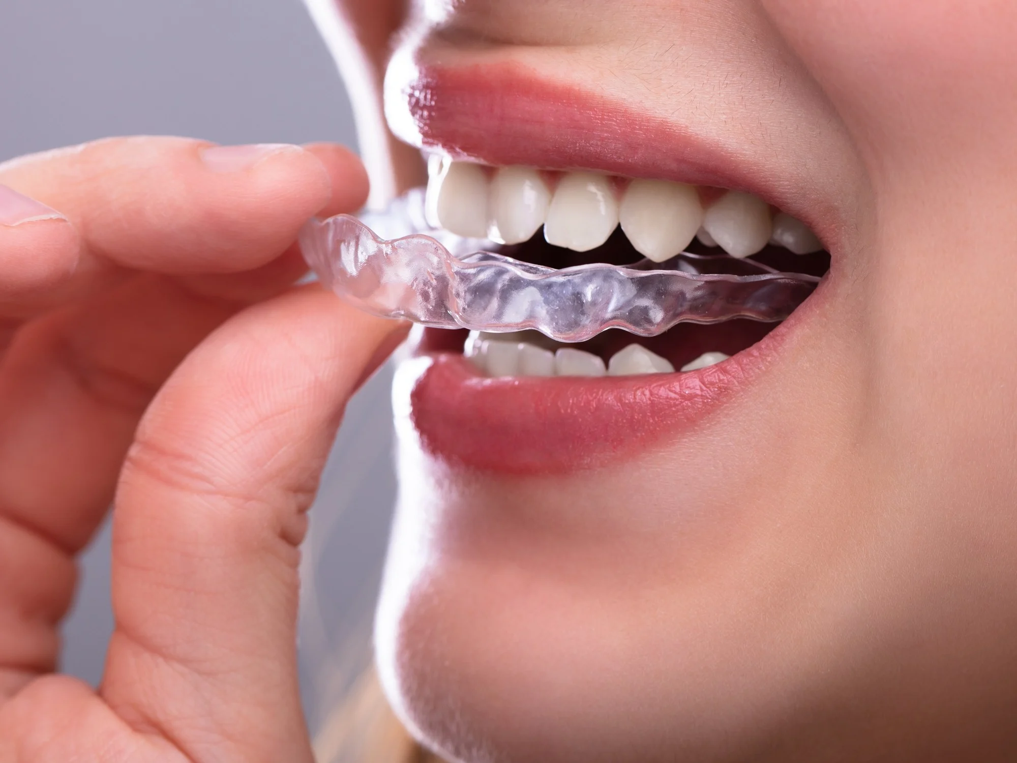 placa de ortodoncia invisible invisalign