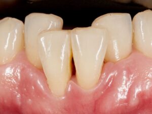 maloclusión y apiñamiento dental