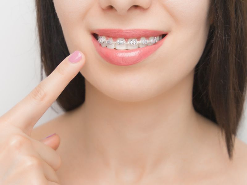brackets metálicos