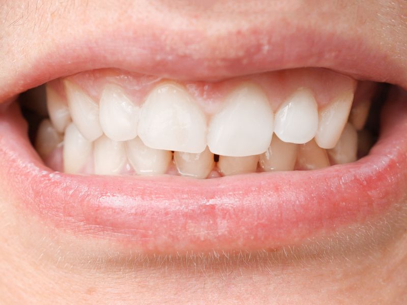 desplazamiento dental brackets metálicos