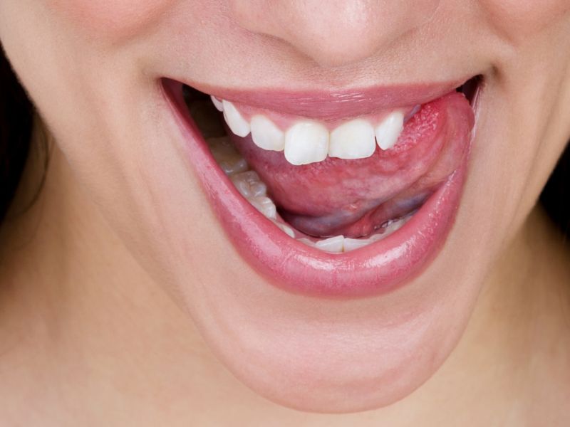 rotación dental brackets metálicos