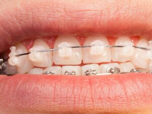 brackets cerámicos