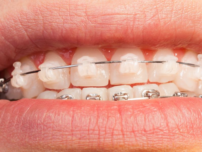 brackets cerámicos