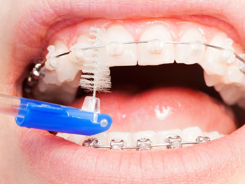 brackets cerámicos