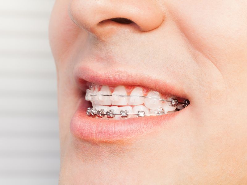 brackets cerámicos