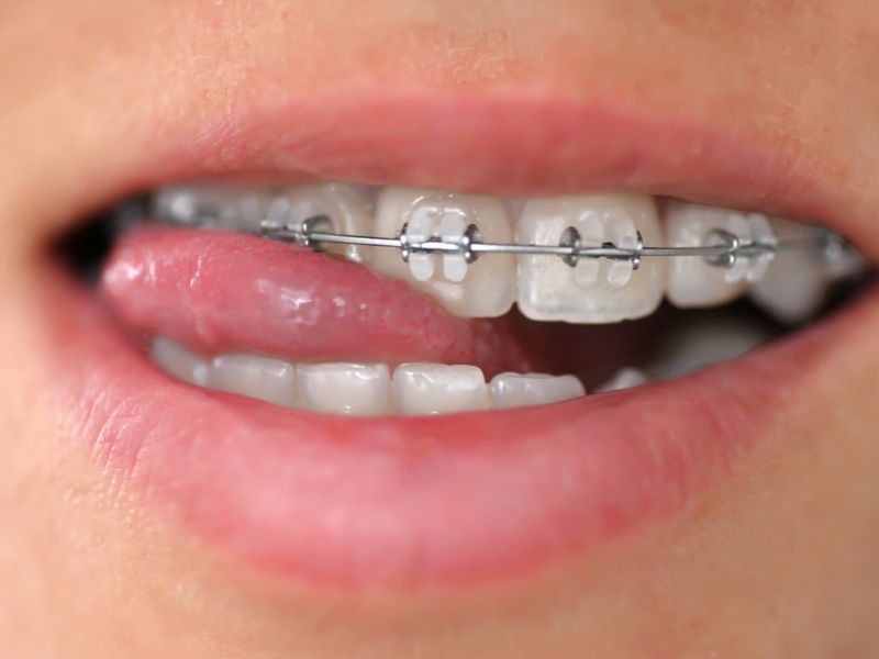 brackets cerámicos