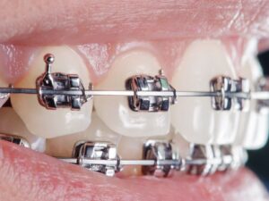 brackets autoligantes