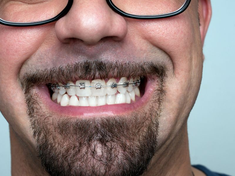 brackets autoligantes