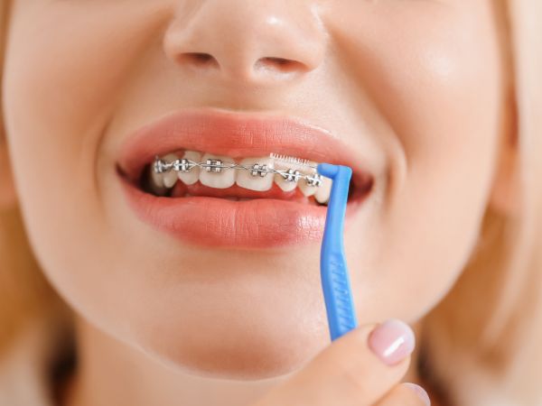Limpieza dental profesional 