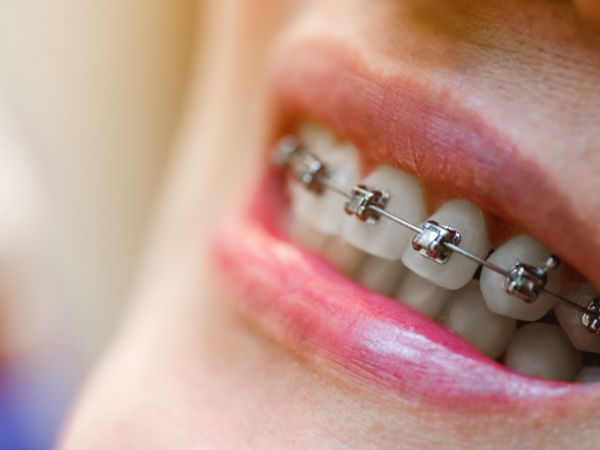 Diferencias entre brackets