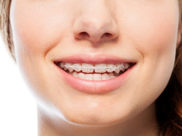 Limpieza dental profesional 