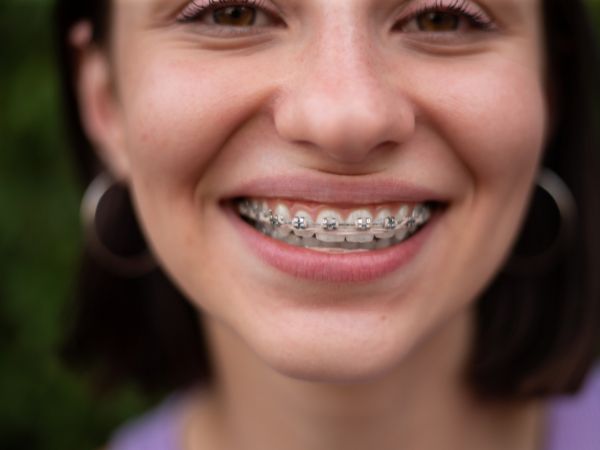 Diferencias entre brackets