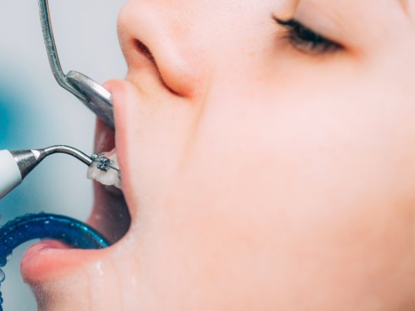 Limpieza dental profesional 