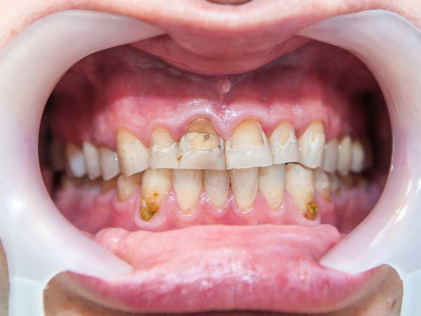 Placa Bacteriana