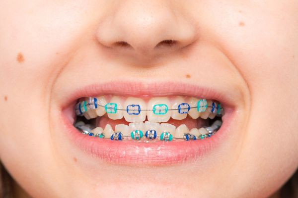tratamiento con brackets