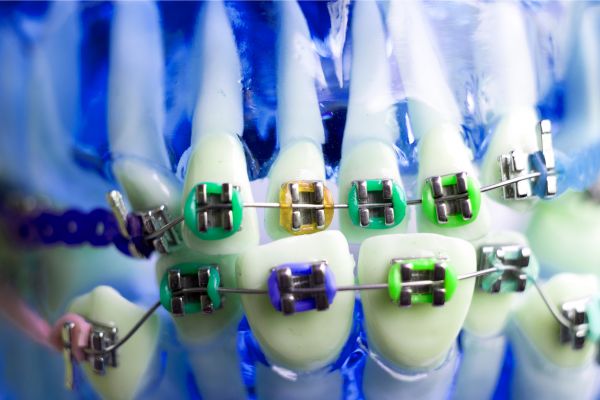 tratamiento con brackets