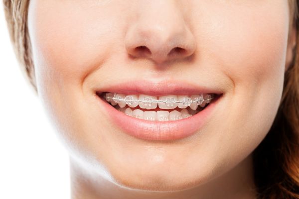 manchas en los brackets